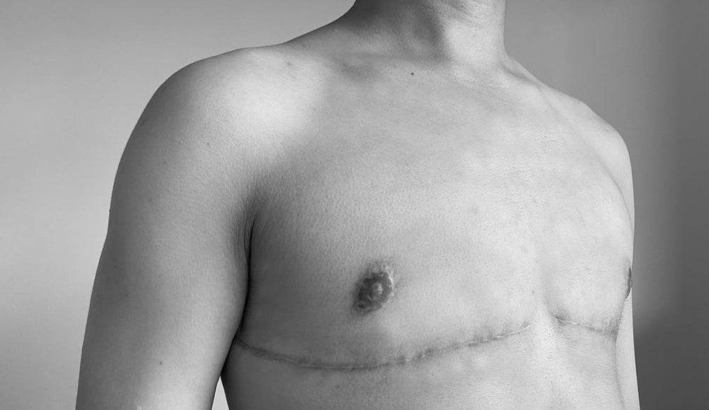 Top Surgery Scars in FTM Individuals: Healing, Care, and Reduction